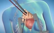 CABG surgery reference