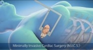 Minimally invasive cardiac surgery